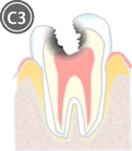 歯髄(神経)に達したむし歯