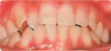 八重歯治療前