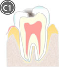 エナメル質内のむし歯