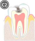 象牙質に達したむし歯