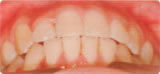 八重歯治療後
